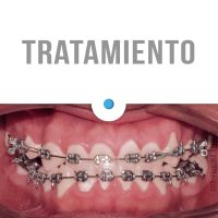 Casos Clínicos Ortodoncia Dinamarca Temuco niños y adultos Frenillos