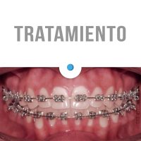 Casos Clínicos Ortodoncia Dinamarca Temuco niños y adultos Frenillos