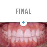 Casos Clínicos Ortodoncia Dinamarca Temuco niños y adultos Frenillos