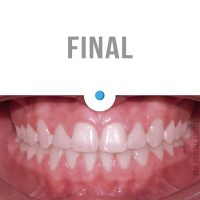 Casos Clínicos Ortodoncia Dinamarca Temuco niños y adultos Frenillos