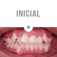 Casos Clínicos Ortodoncia Dinamarca Temuco niños y adultos Frenillos