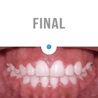 Casos Clínicos Ortodoncia Dinamarca Temuco niños y adultos Frenillos