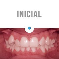 Casos Clínicos Ortodoncia Dinamarca Temuco niños y adultos Frenillos